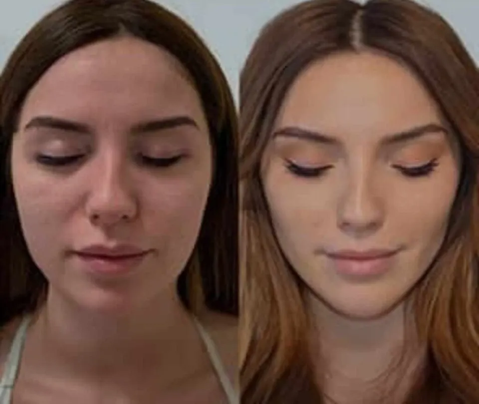 buccal fat removal before and after 
