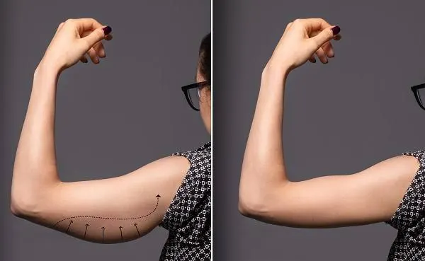 Arm liposuction before and after