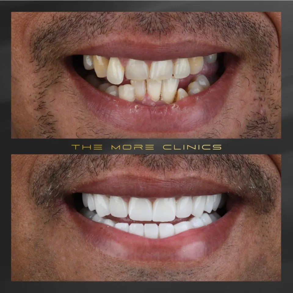 Veneers for crooked front teeth before and after — misaligned teeth fixed