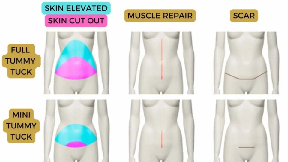 mini tummy tuck vs full tummy tuck