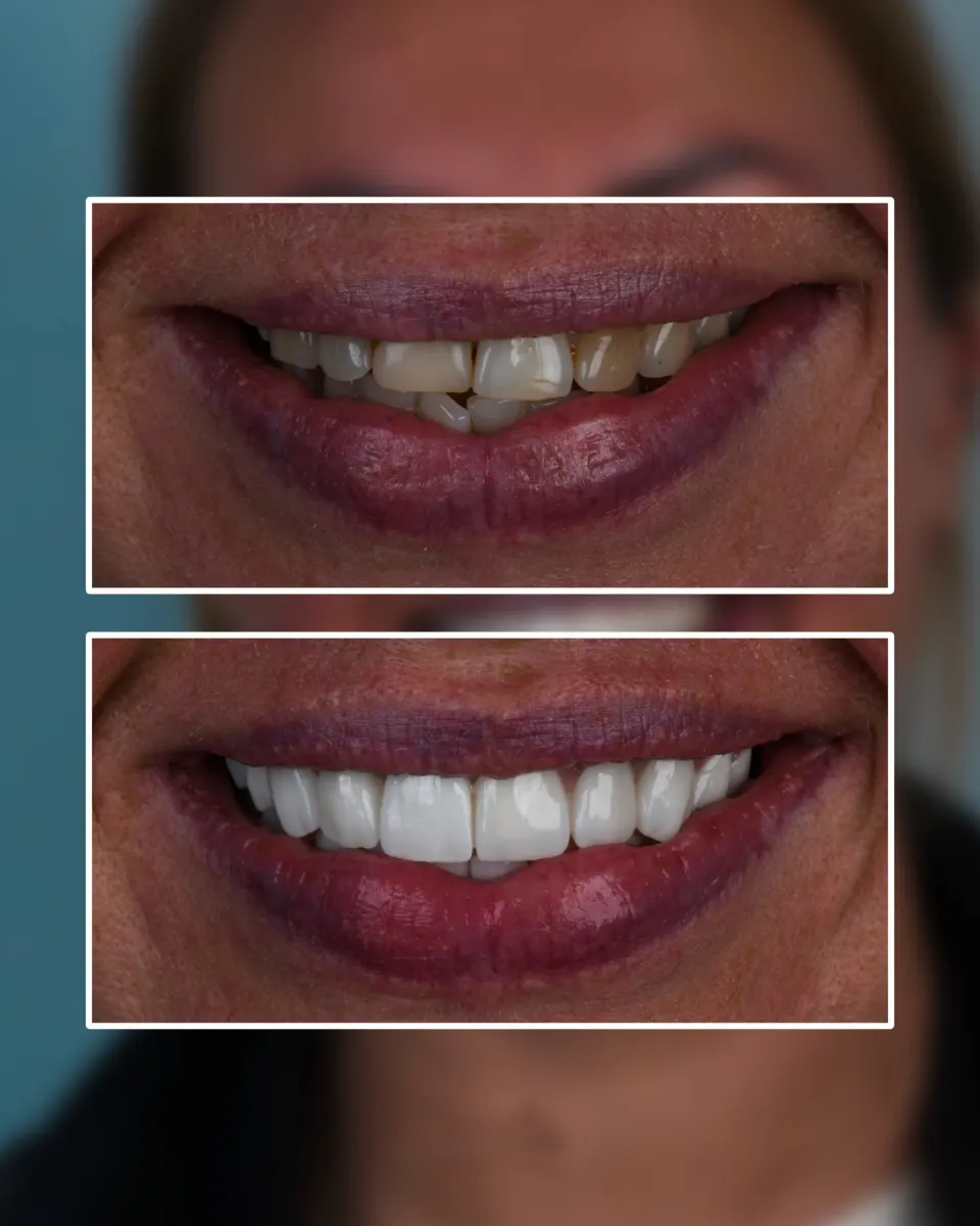 General Dental Treatments in Turkey: Root Canals, Fillings & More