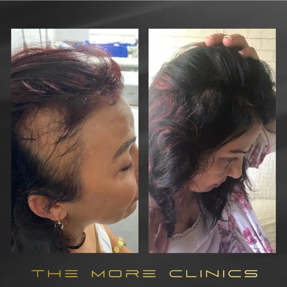 haartransplantation frauen vorher nachher