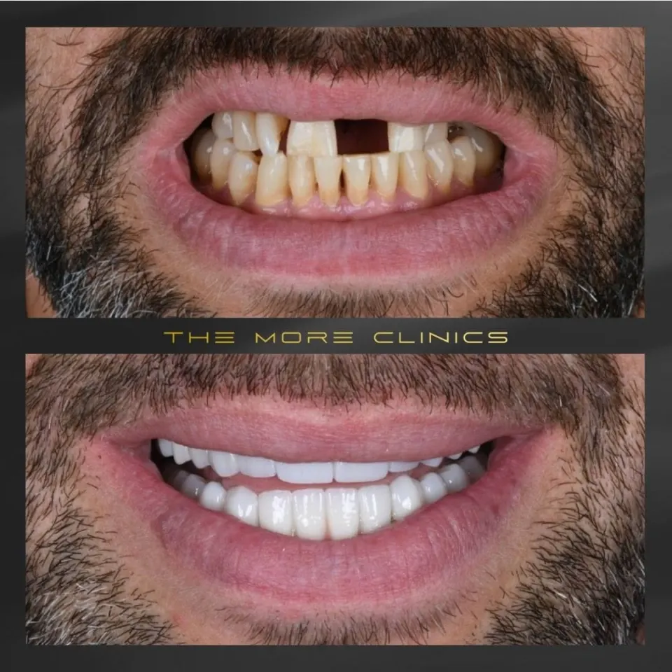 Dental before & after 14