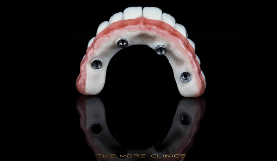 all on 4 dental implants turkey