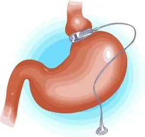 Antalya Gastric Band Surgery