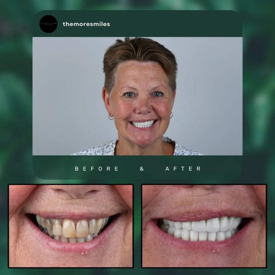 veneers cost turkeynn