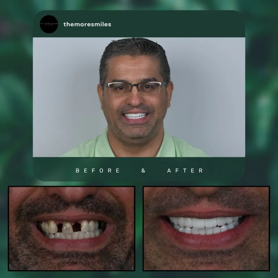 Multiple missing teeth replaced with implants Turkey before and after