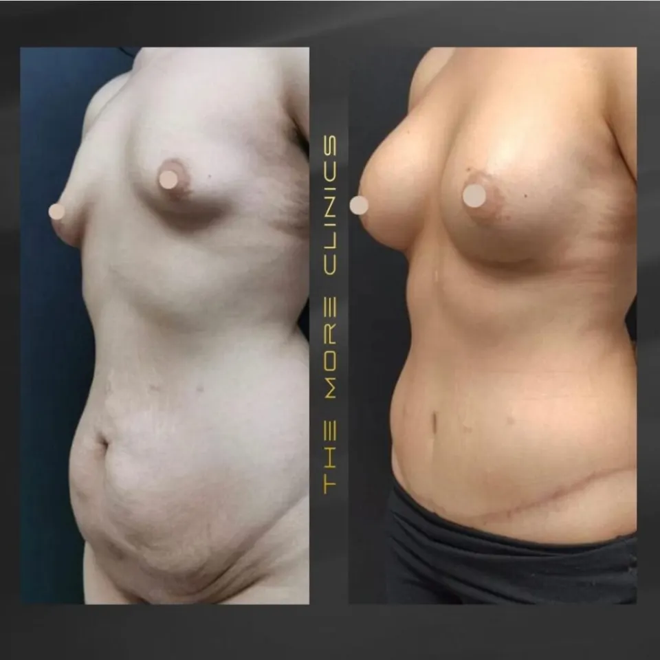 a full or mini tummy tuck before after result is right for you?