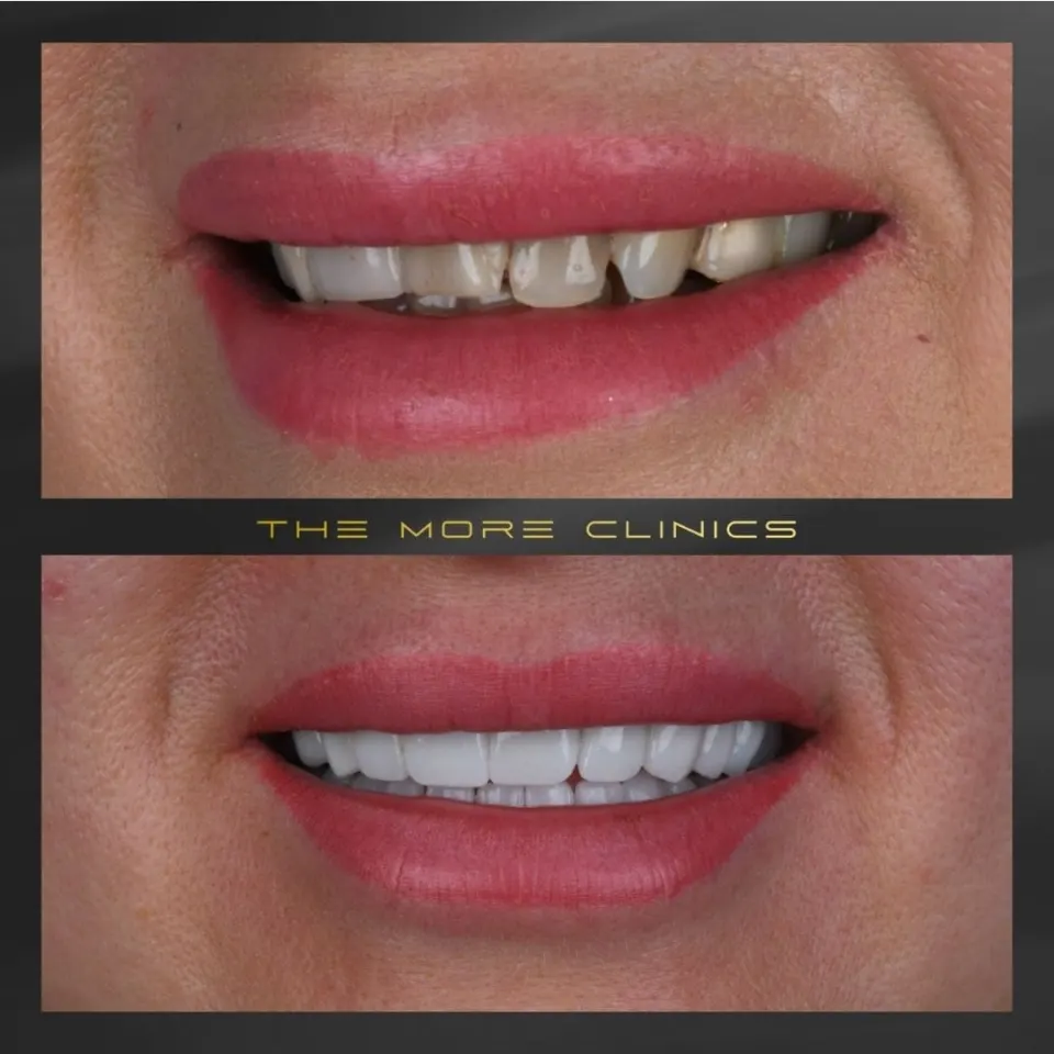 Dental before & after 30
