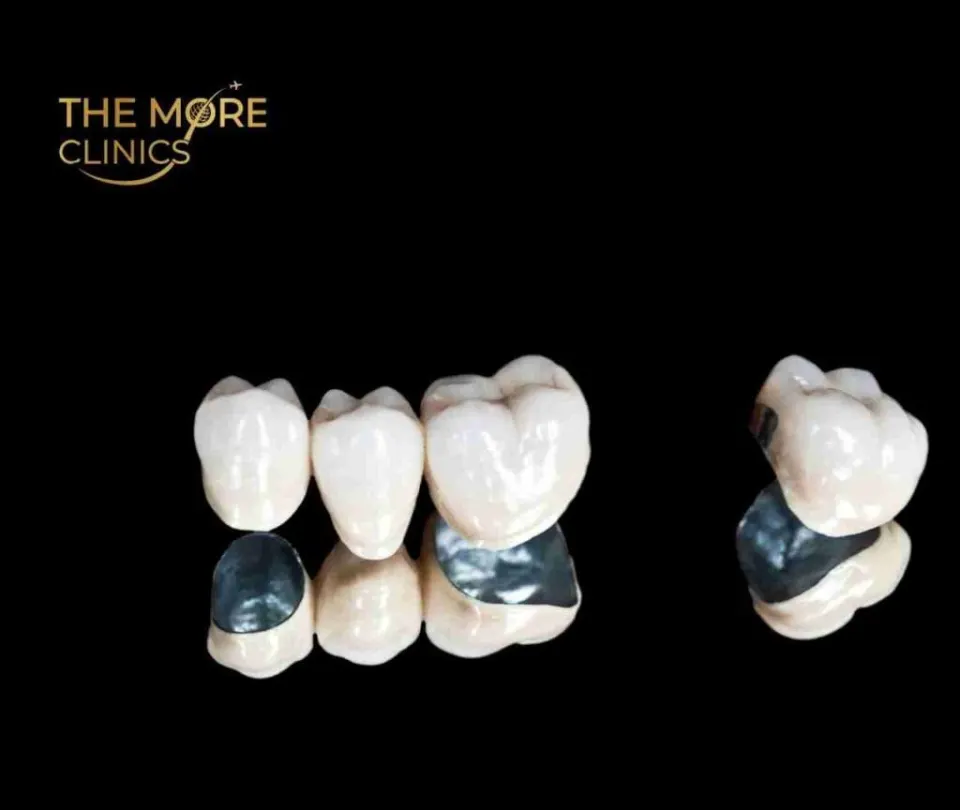 Metal crown — most affordable durable crown for back teeth