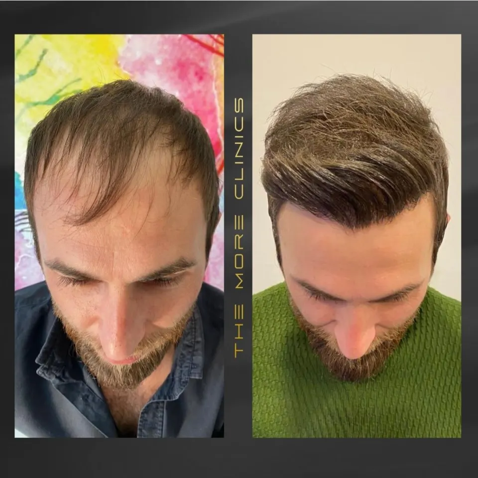 Haartransplantation vorher nachher Türkei Antalya