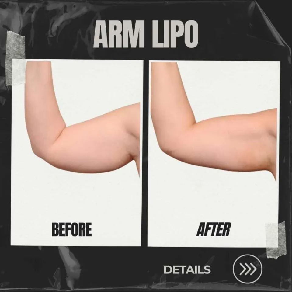 arm liposuction before and after