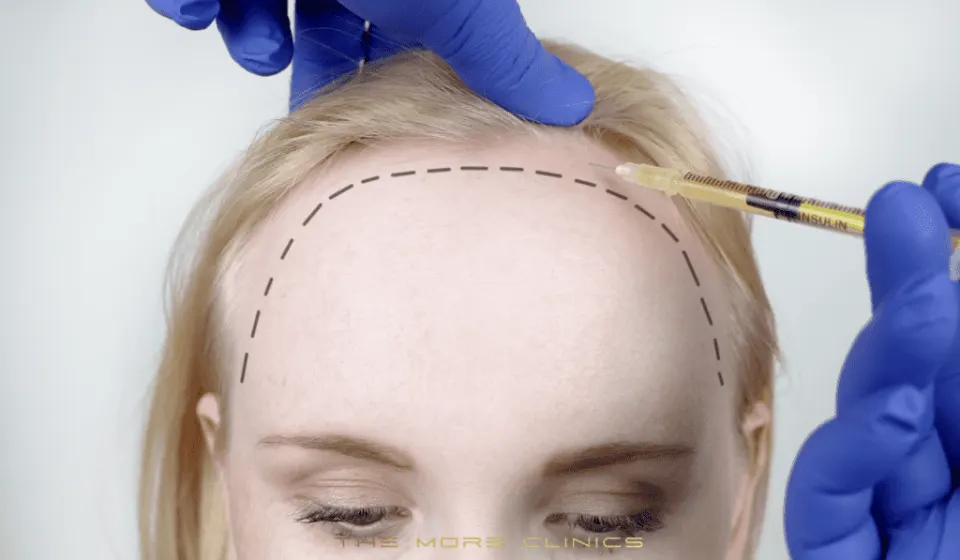 Antalya Woman Hair Transplant