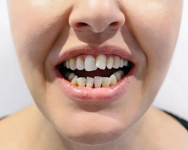 Crooked teeth — causes, treatments and how to fix misaligned teeth 2026
