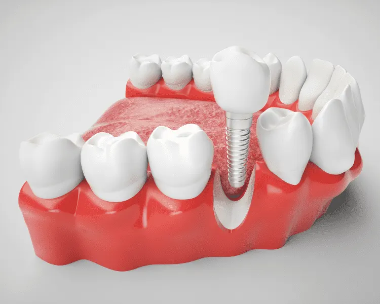 Antalya Dental Implants