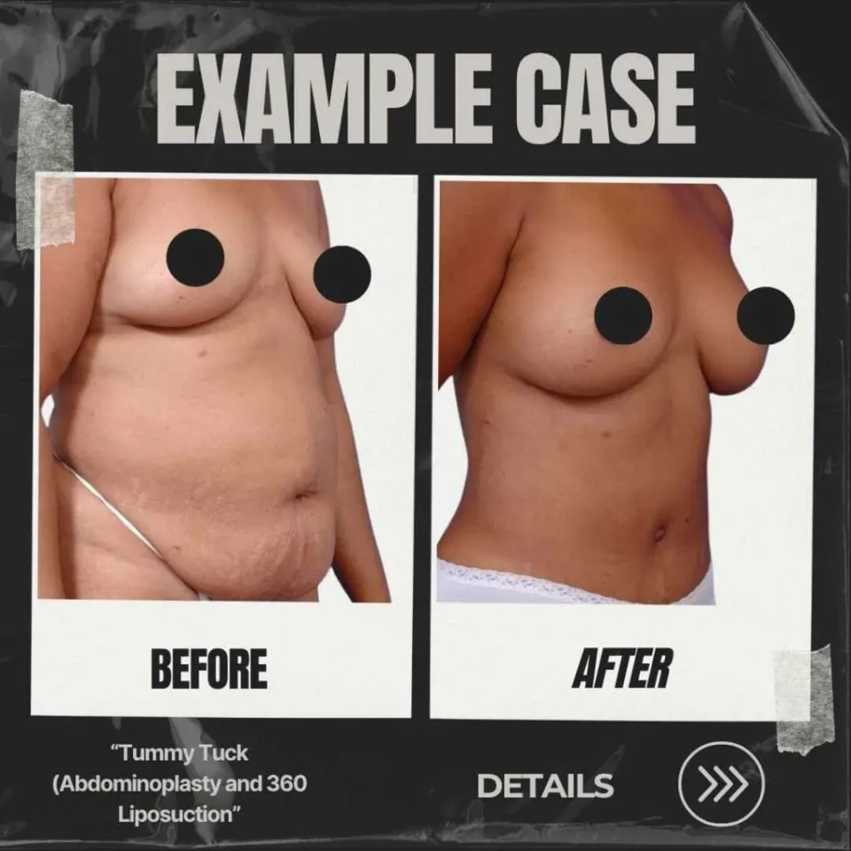 abdominoplastie inversée avant après