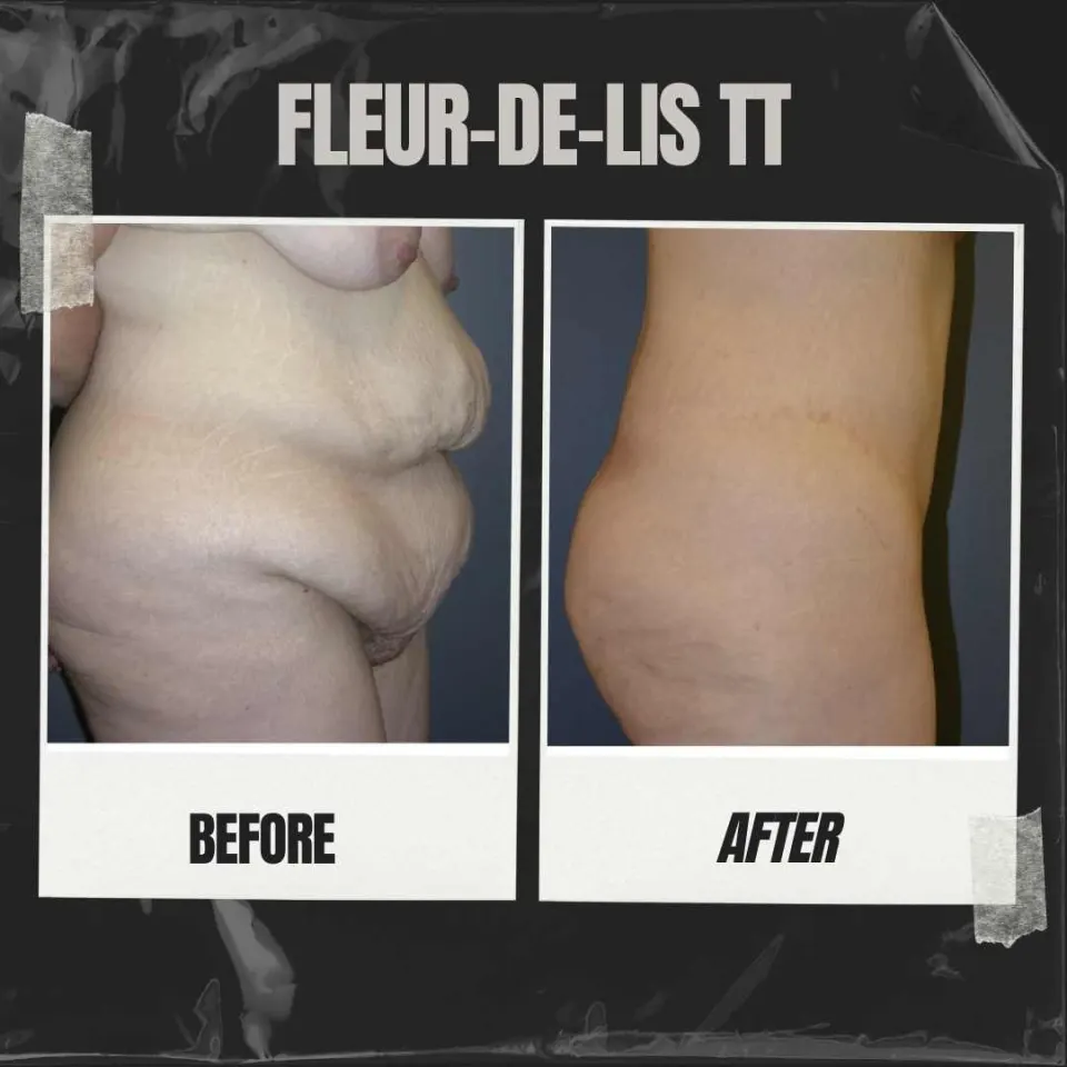 fleur de lis tummy tuck before and after results can vary