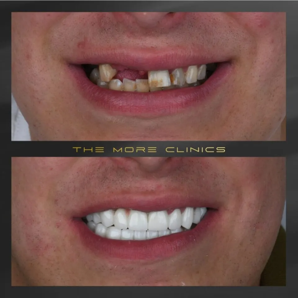 Dental results 5
