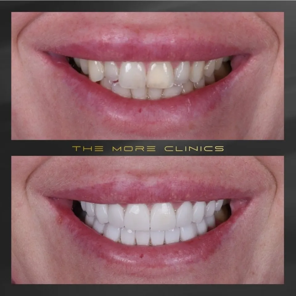 Dental before & after 16
