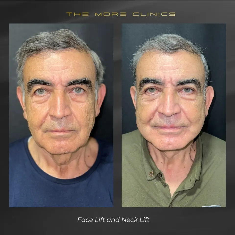 Aesthetic before & after 9
