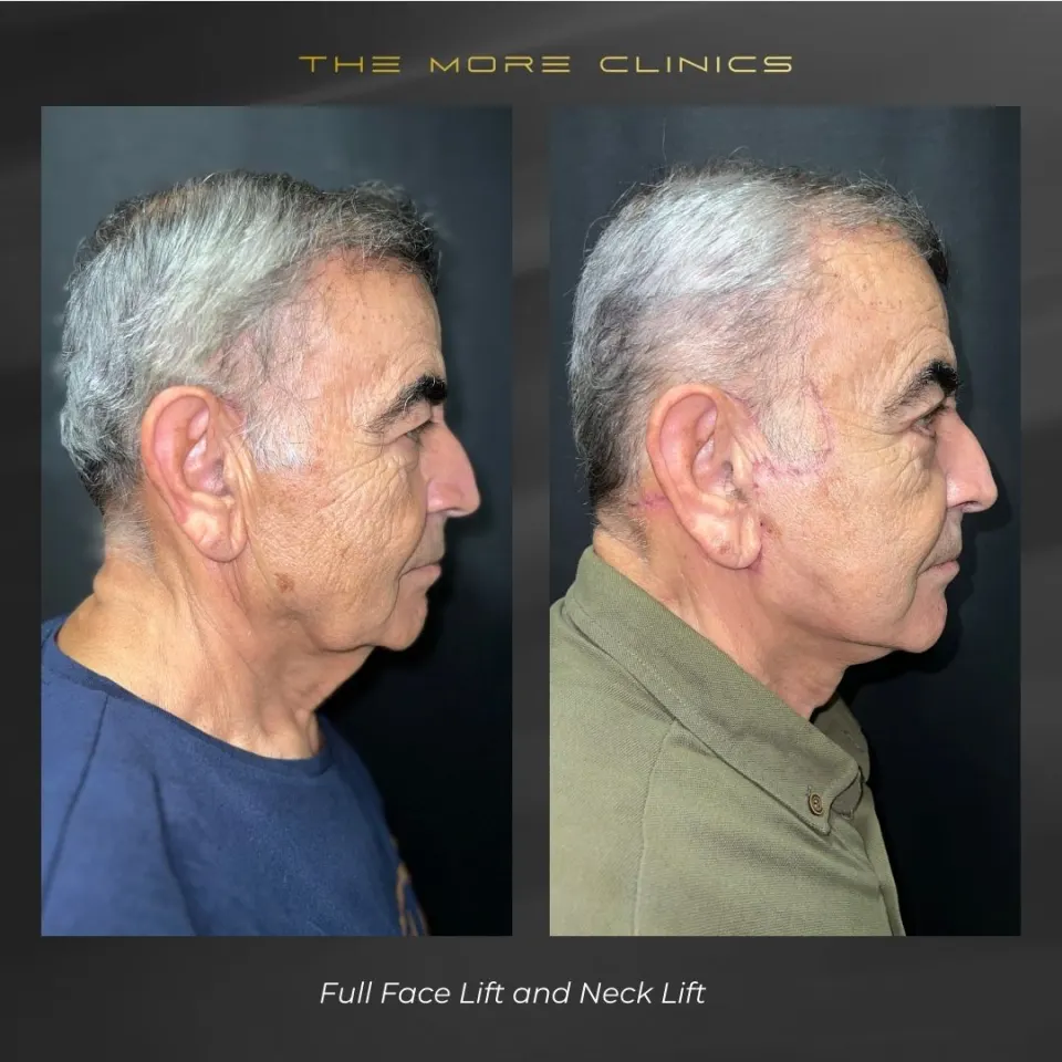 Aesthetic before & after 8