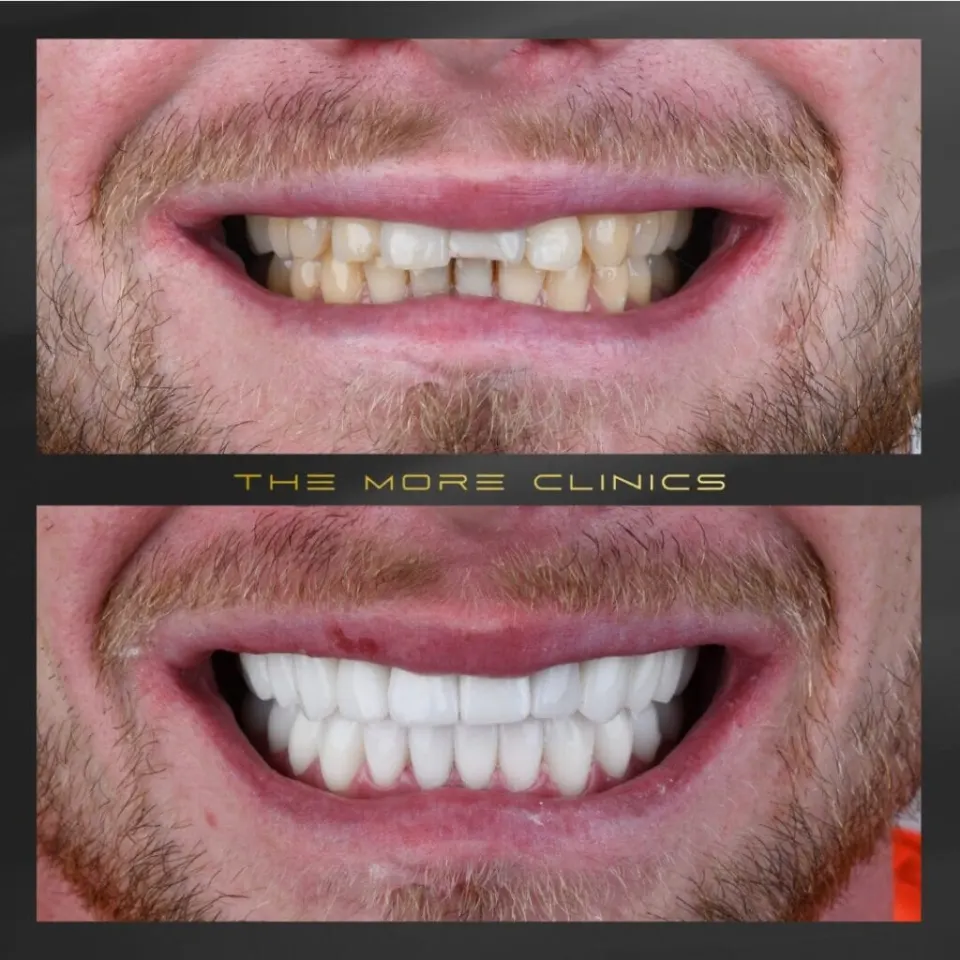 sonrisa hollywood con coronas dentales antes y después