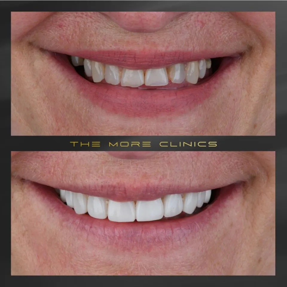 composite bonding before after