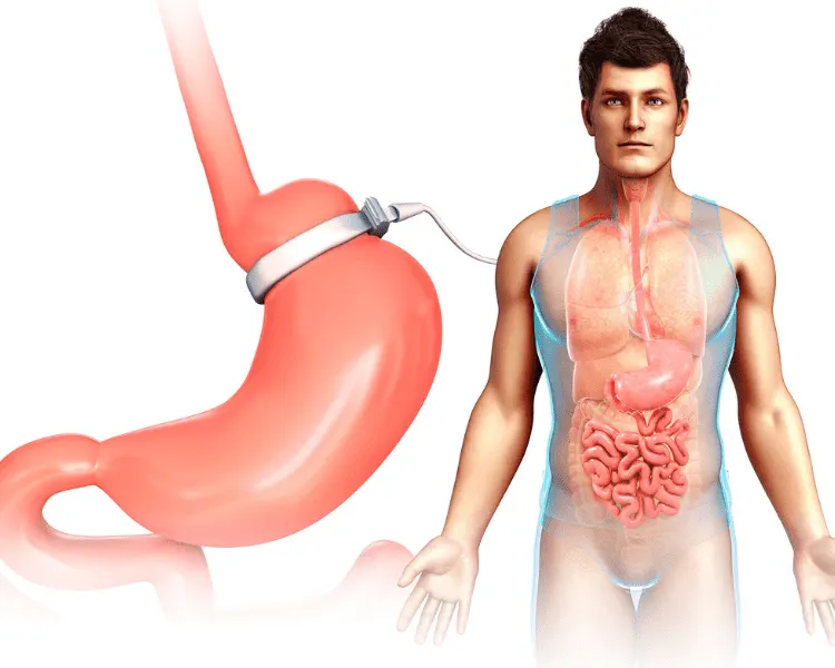 gastric band (lap band)