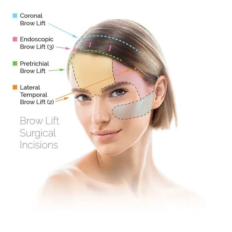 antalya turkey brow lift scars and incision