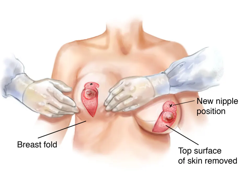 breast lift in turkey procedure showing incisions