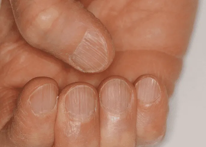 toenail and fingernail changes in alopecia areata progression