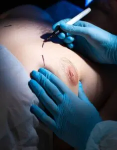 breast reduction of male
