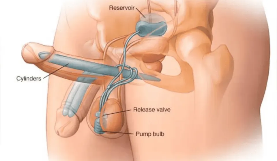Inflatable Implants