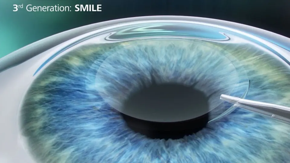 Antalya Relex Smile Eye Laser Turquía