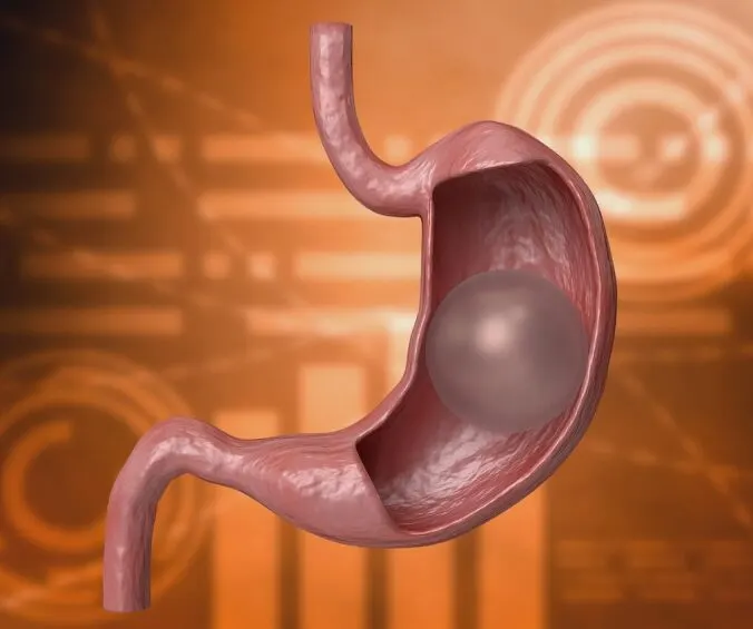 GASTRIC BALLOON