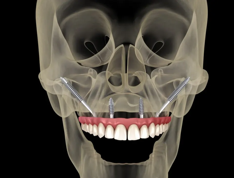 zigomatik tam çene diş implantları
