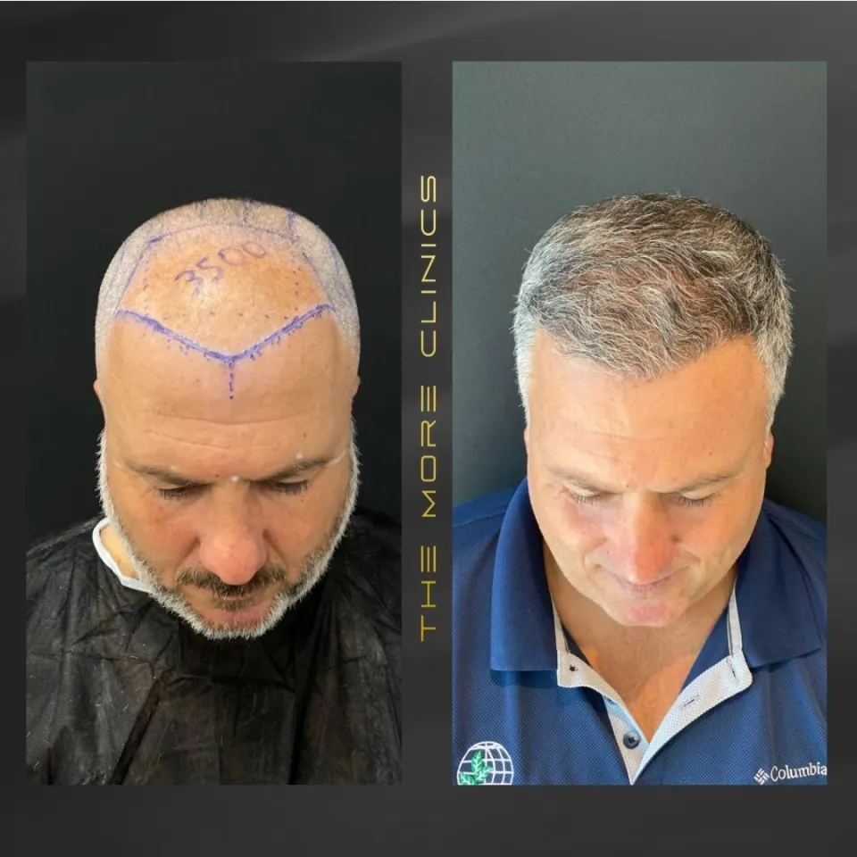 Haartransplantation vorher nachher Türkei Antalya