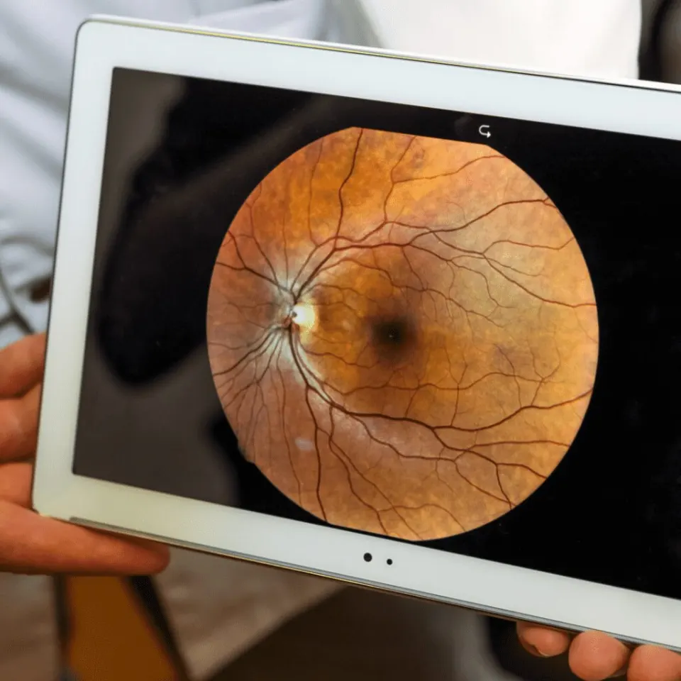 glaucoma treatment options -The Morev Clinics Turkey