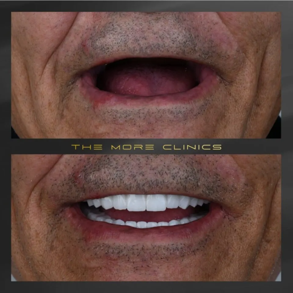 Single tooth dental implant Turkey before and after result
