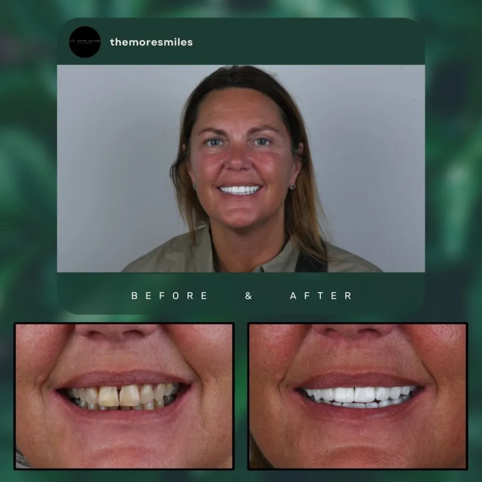 Antalya Dental Crowns