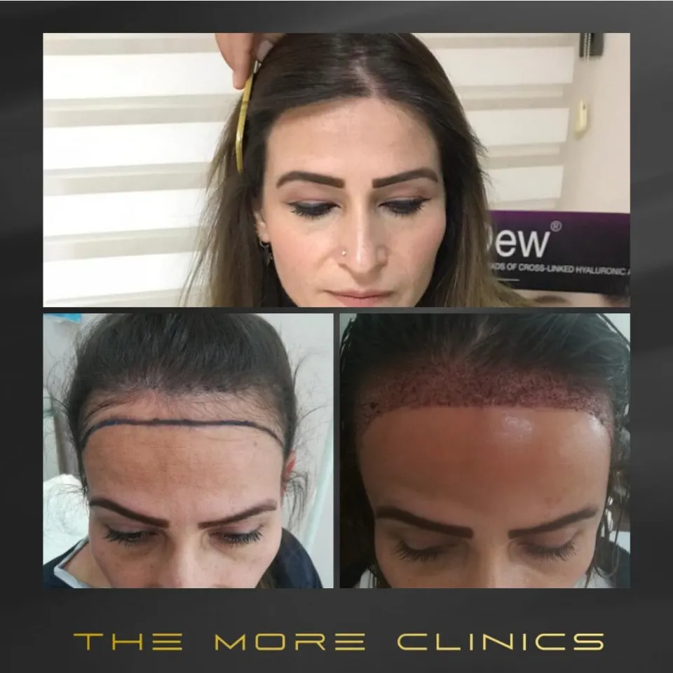 haartransplantation frauen vorher nachher