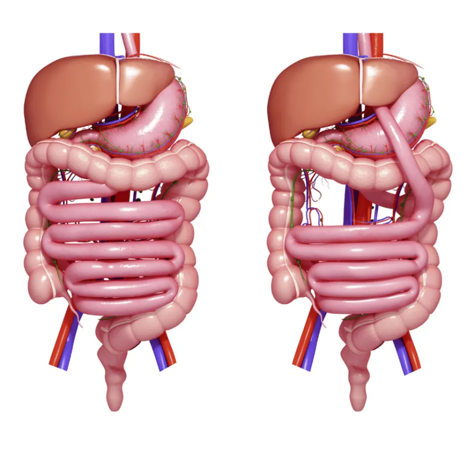 GASTRIC BYPASS