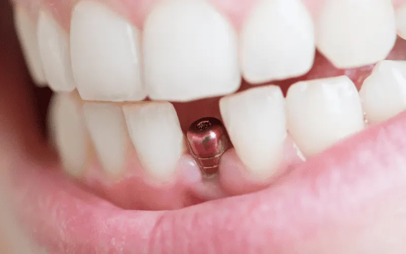 dental implant aftercare, Swelling