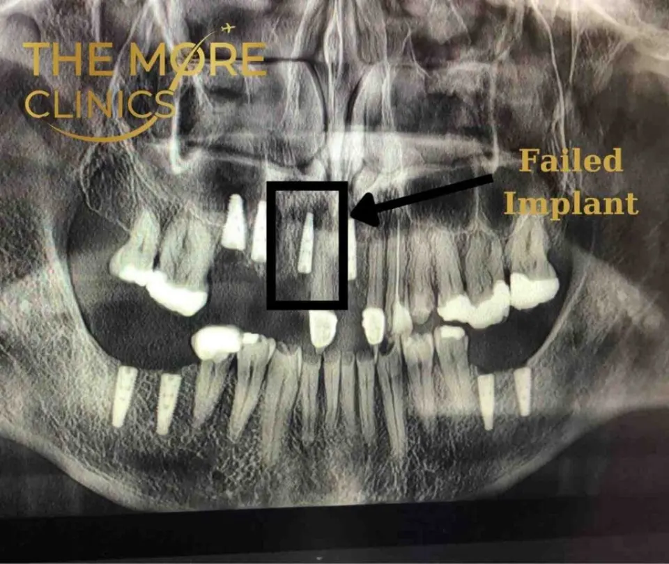 1 failed dental implant x ray
