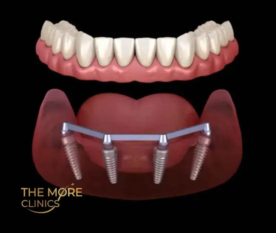 all on 4 implant dentures cost turkey