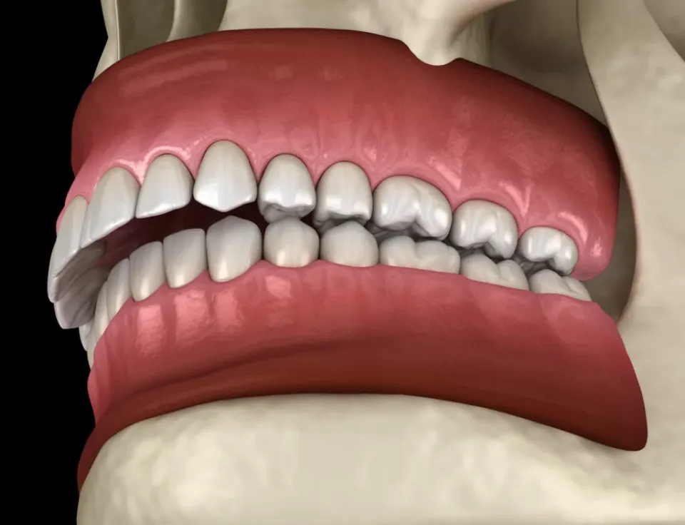 Malocclusion overbite underbite — misaligned jaw crooked teeth