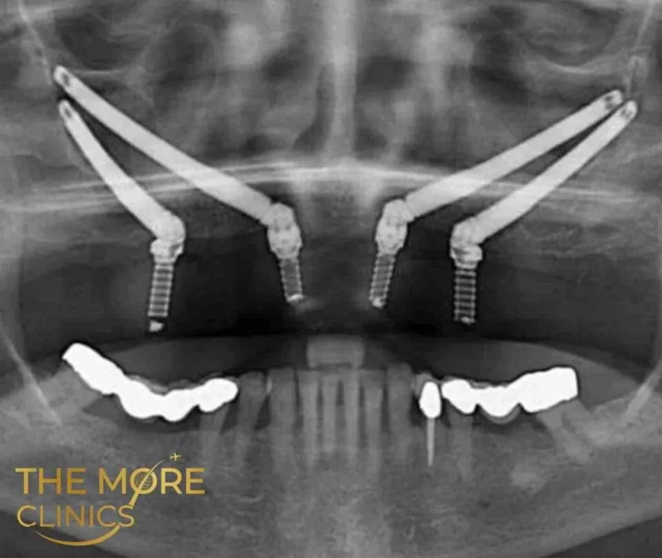 Implants zygomatiques en Turquie avant et après