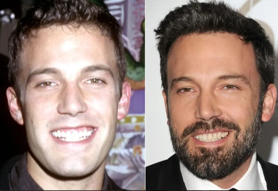 Ben Affleck Teeth Before and After