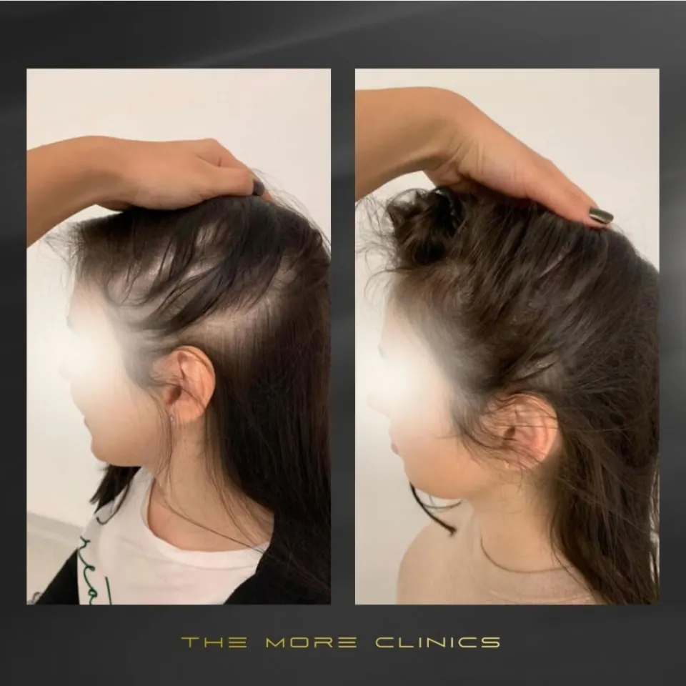 Women hair transplant before and after Turkey result