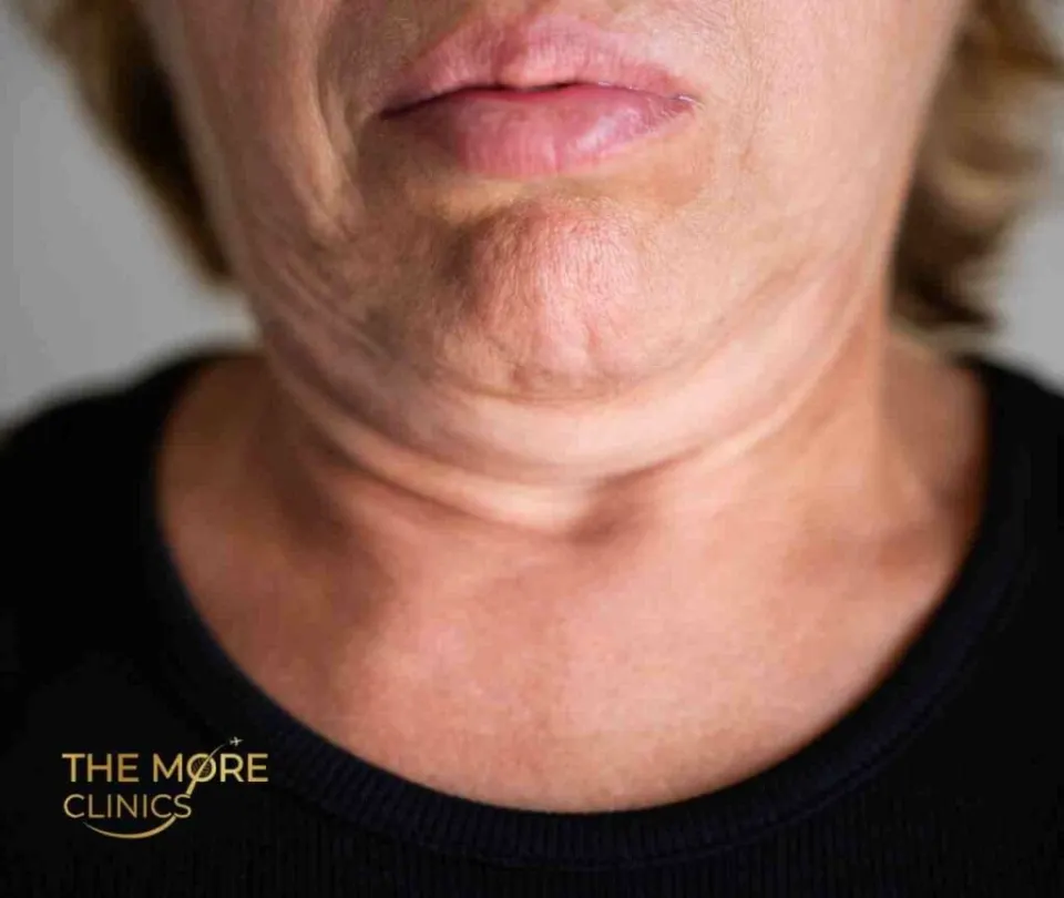 double chin liposuction turkey